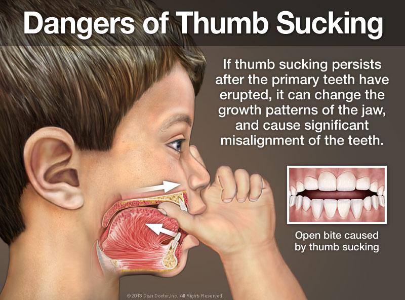 dangers-of-thumb-sucking
